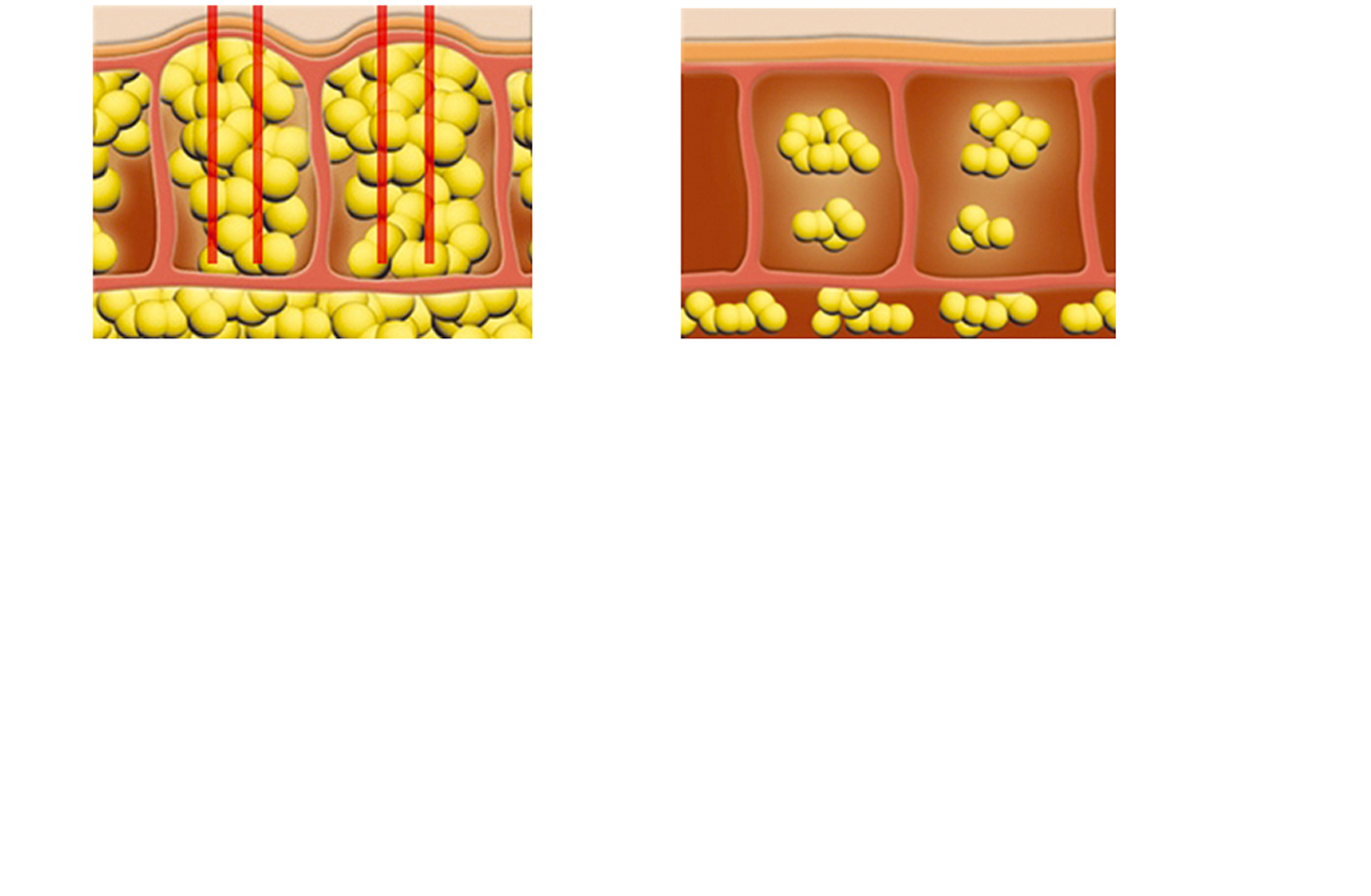 Materiel Esthetique Anti
Cellulite