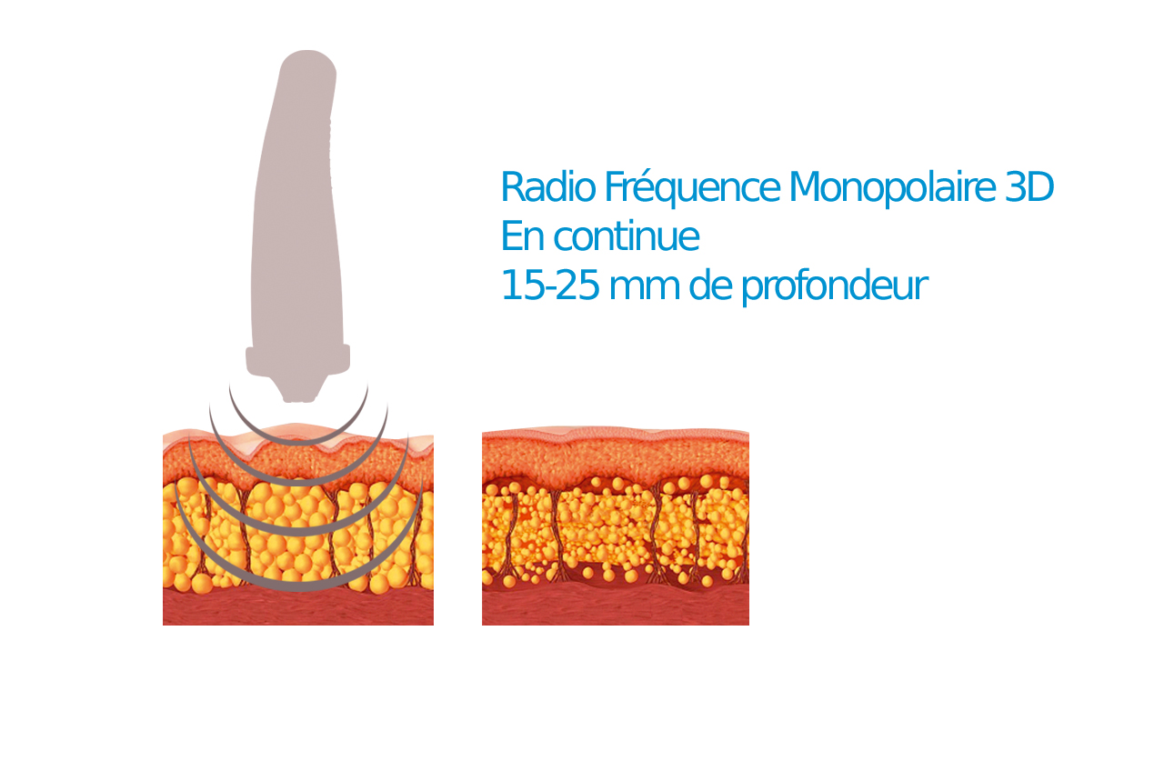 Materiel-Esthetique-Radiofrequence-Monopolaire