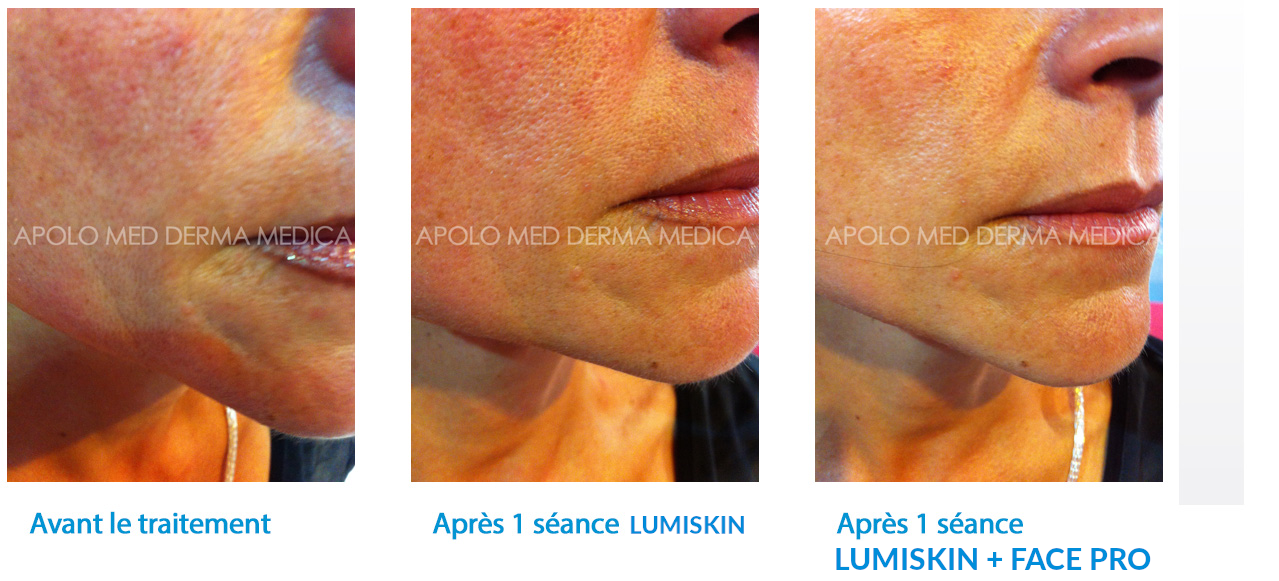 Machine-Amincissement-Par-Lipocavitation