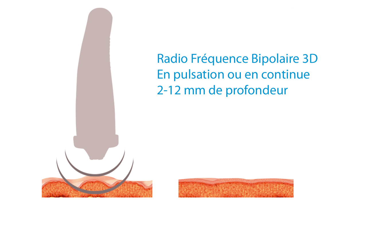 Radio-Frequence-3D